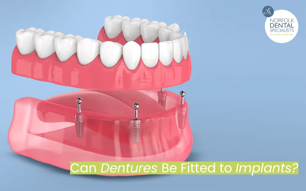 denture arch above dental implants