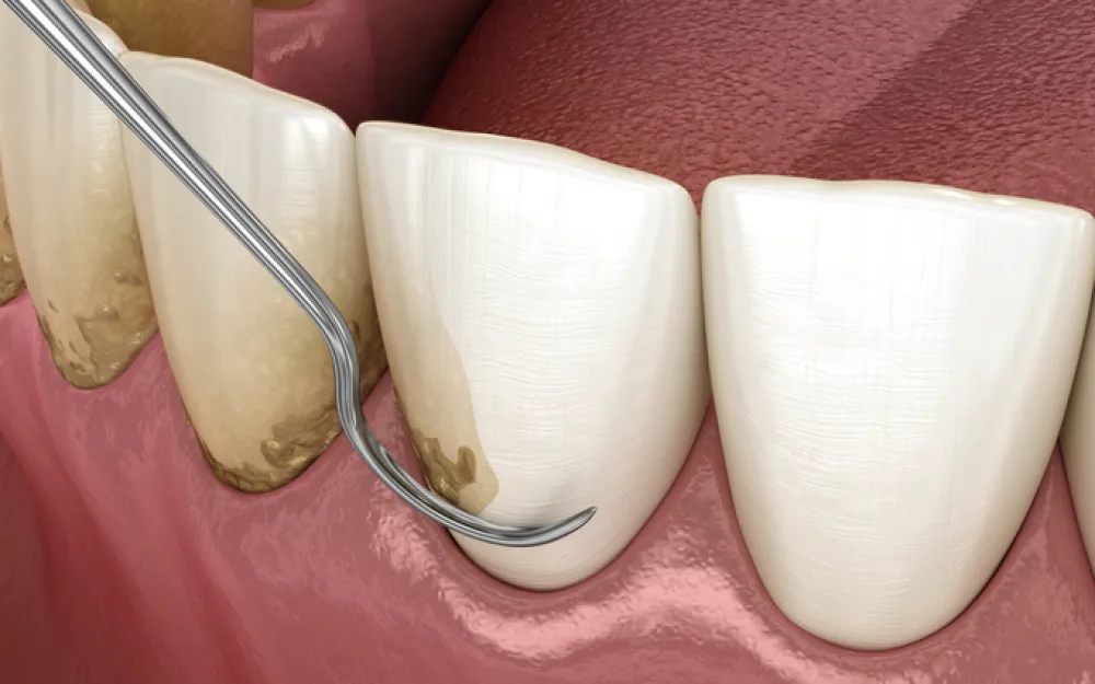 scaling and root planing to remove plaque from below the gumline