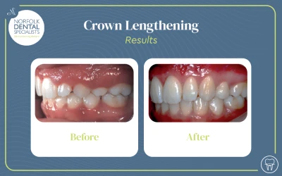 before and after images of teeth with the crown lengthening treatment
