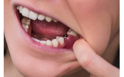 Reasons to Consider Replacing Missing Teeth